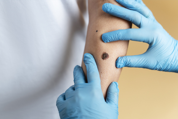 Mole, Cyst & Skin Tag Removal service